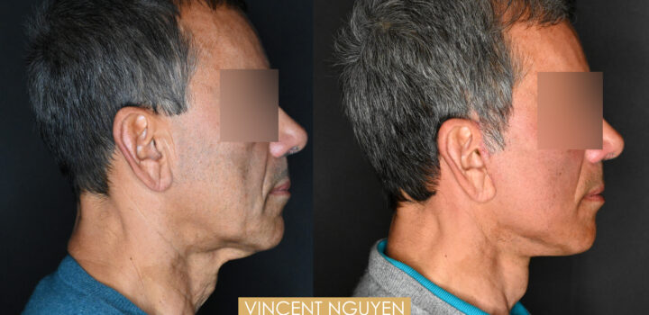 lifting cervico facial