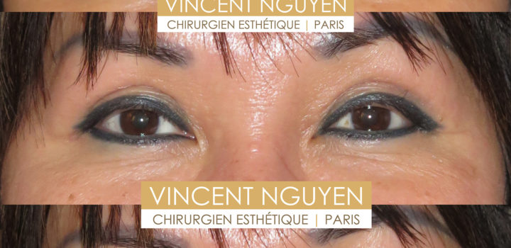 blépharoplastie supérieure