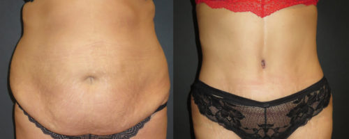 abdominoplastie