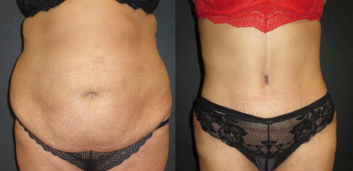 abdominoplastie