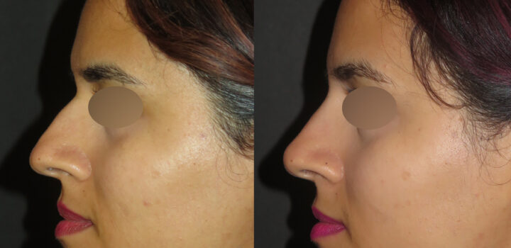 rhinoplastie medicale