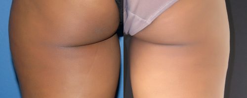 Lipoaspiration de la culotte de cheval