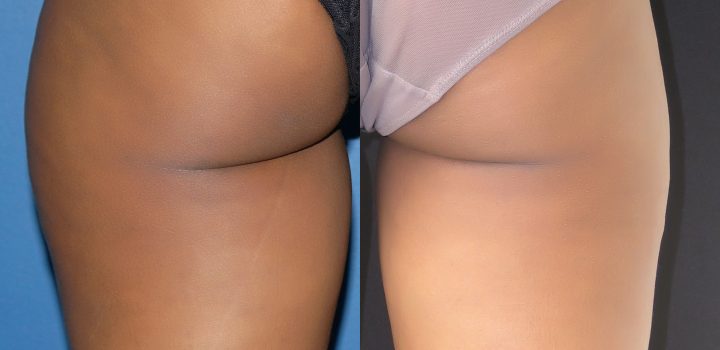 Lipoaspiration de la culotte de cheval