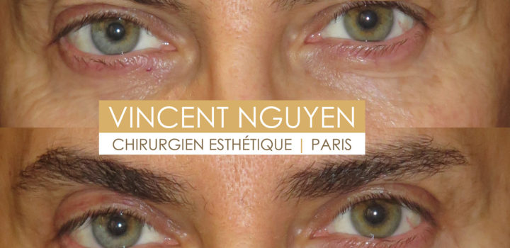 blépharoplastie supérieure