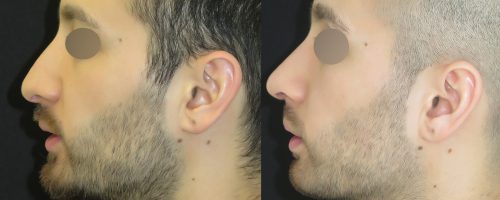 rhinoplastie de pointe