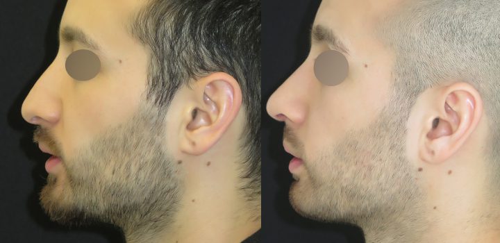 rhinoplastie de pointe