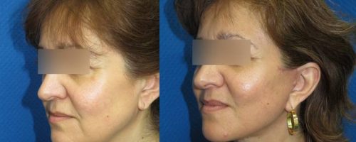 Lifting cervico-facial