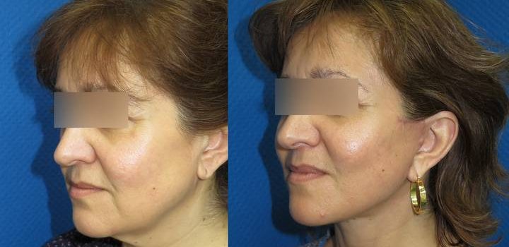 Lifting cervico-facial