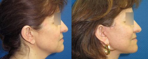 Lifting cervico-facial