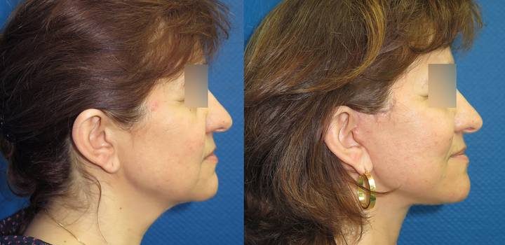 Lifting cervico-facial