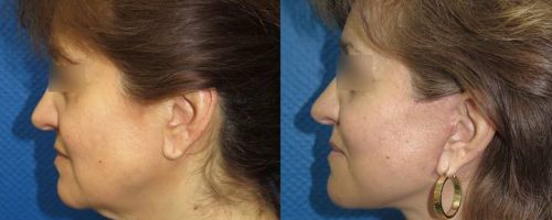 Lifting cervico-facial