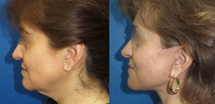 Lifting cervico-facial