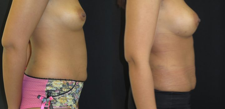 augmentation mammaire par lipofilling
