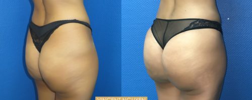 Lipofilling des fesses