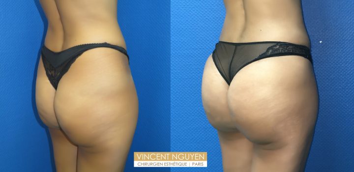 Lipofilling des fesses