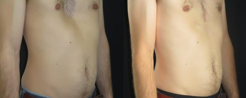 Pectus excavatum par prothèse sur mesure