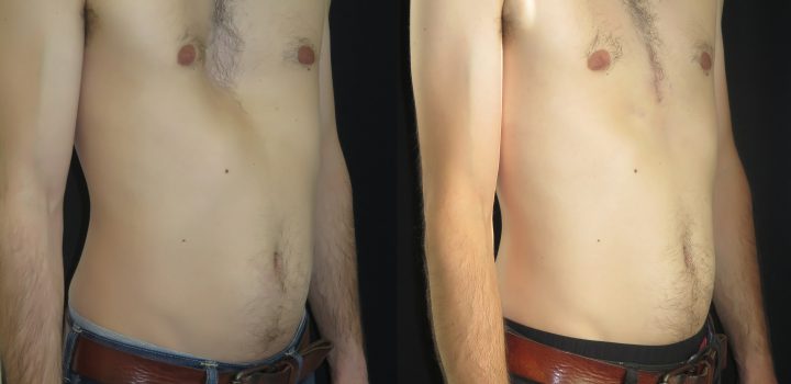 Pectus excavatum par prothèse sur mesure