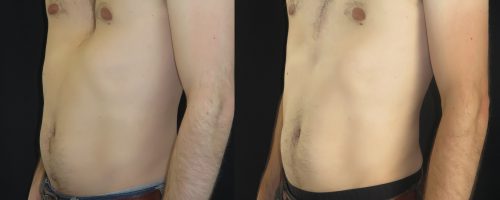 Pectus excavatum par prothèse sur mesure