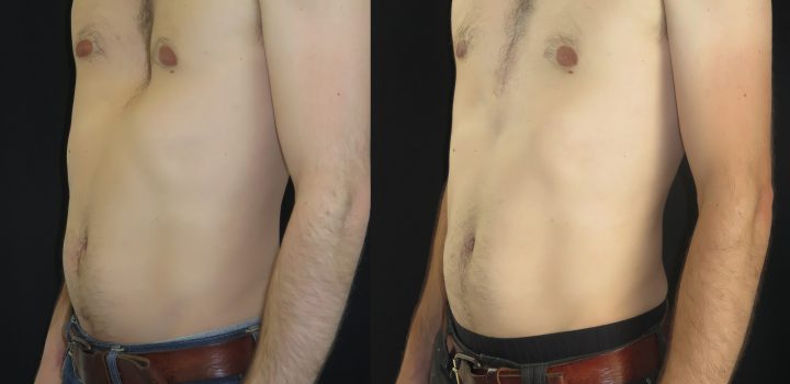 Pectus excavatum par prothèse sur mesure