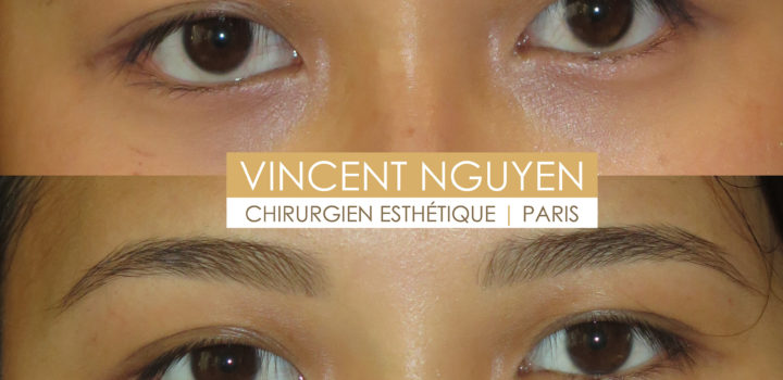 blépharoplastie asiatique