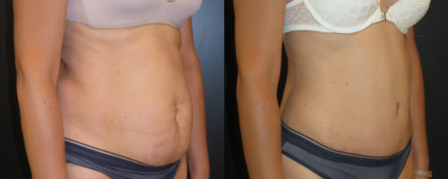 abdominoplastie