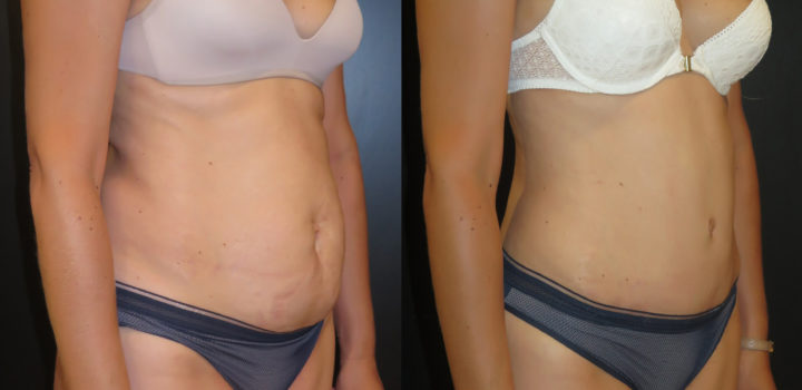 abdominoplastie