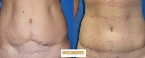 MiniAbdominoplastie pour reprise de plastie abdominale - résultat à 2 mois (2)