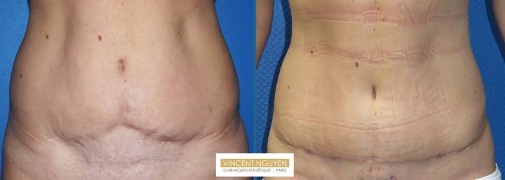 MiniAbdominoplastie pour reprise de plastie abdominale - résultat à 2 mois (2)