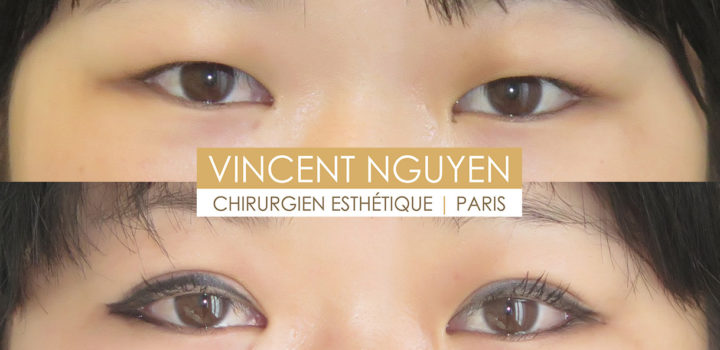 Blépharoplastie asiatique