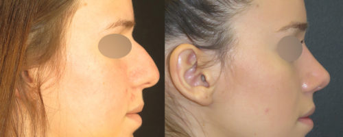 Rhinoplastie