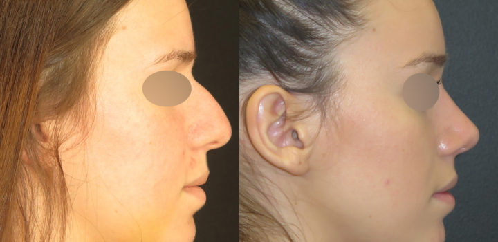 Rhinoplastie