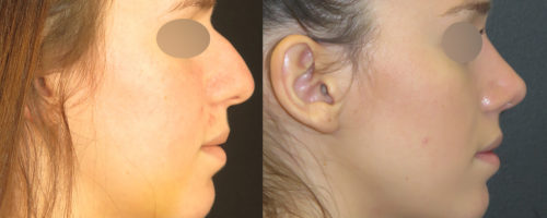 rhinoplastie