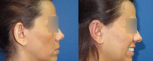 Otoplastie pour oreilles décollées - résultat à 3 mois (4)