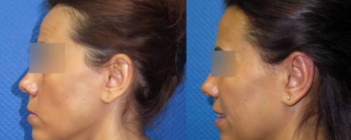Otoplastie pour oreilles décollées - résultat à 3 mois (5)