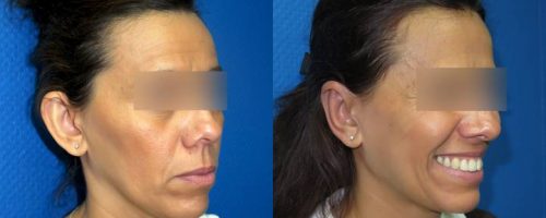 Otoplastie pour oreilles décollées - résultat à 3 mois (6)