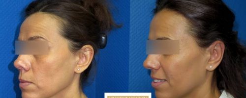 Otoplastie pour oreilles décollées - résultat à 3 mois (7)