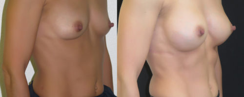 Augmentation mammaire prothèse type dual plan