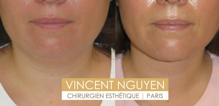 lipoaspiration double menton