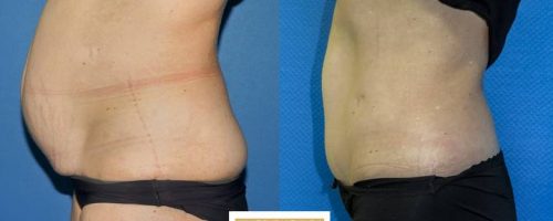 Plastie abdominale avec transposition de l'ombilic et cure de diastasis- résultat à 6 mois (1)