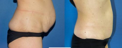 Plastie abdominale avec transposition de l'ombilic et cure de diastasis- résultat à 6mois (2)