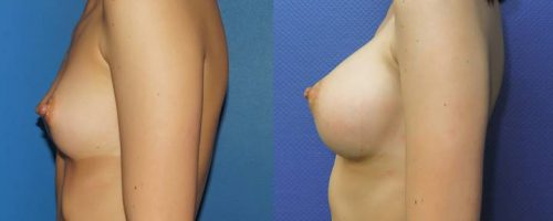 Prothèses mammaires DUAL PLAN - résultat à 2 mois (1)