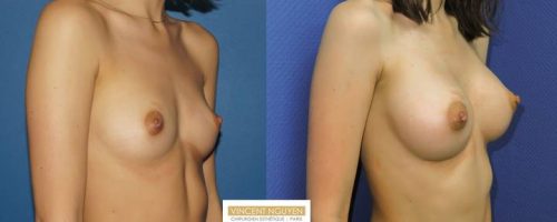 Prothèses mammaires DUAL PLAN - résultat à 2 mois (2)