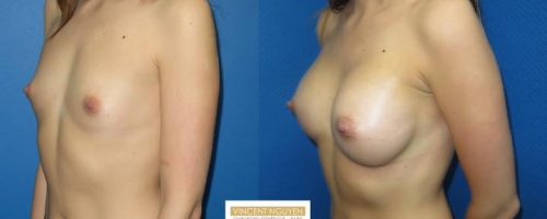 Prothèses mammaires - résultat à 1 mois