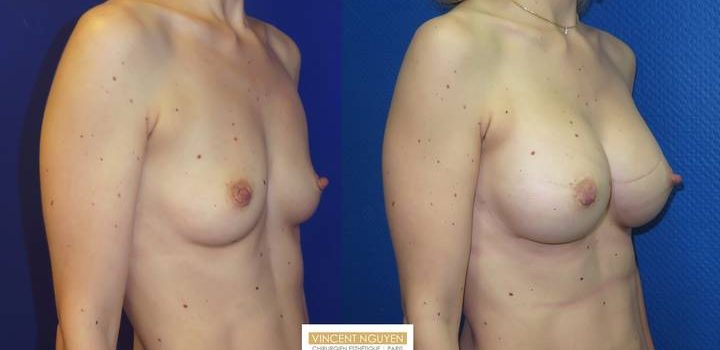 Prothèses mammaires - résultat à 1 mois (1)