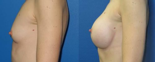 Prothèses mammaires - résultat à 2 mois