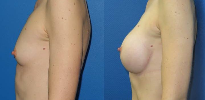 Prothèses mammaires - résultat à 2 mois
