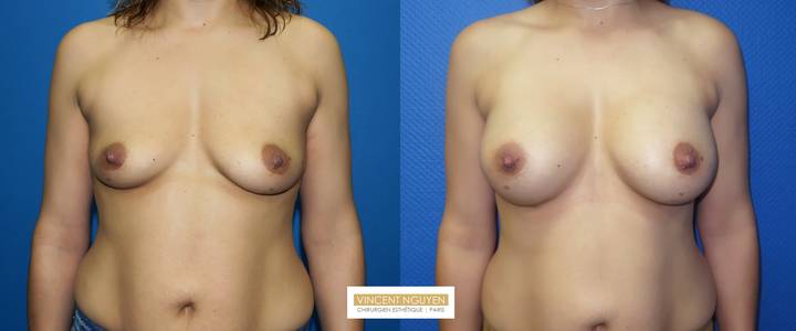 Prothèses mammaires - résultat à 6 mois(4)