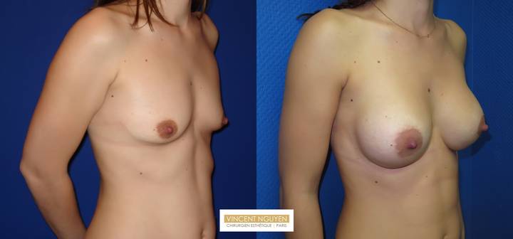 Prothèses mammaires - résultats à 3 mois (1)