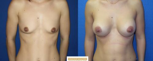 Prothèses mammaires - résultats à 3 mois (3)