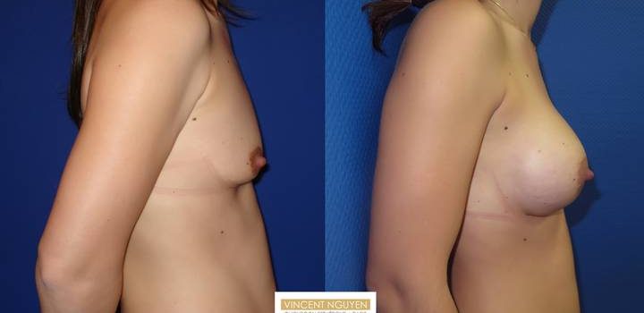 Prothèses mammaires - résultats à 3 mois (4)